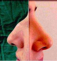 Before And After Nasal Plastic Surgery In Manchester Pics