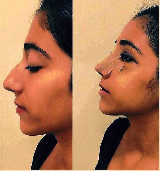 Before And After Nose Job Gaziantep, Turkey » Rhinoplasty Cost, Pics, Reviews, Q&A