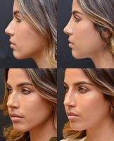Before And After Nose Job Surgery Newport Beach, CA, US Images