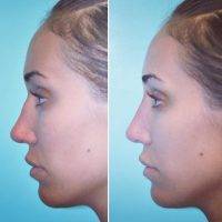 Before And After Nose Job in New Jersey