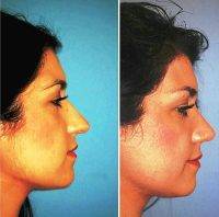 Before And After Nose Reduction PA Pictures Dr. Robert J. Chiu, MD