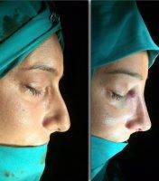 Before And After Nose Reshaping In Jacksonville