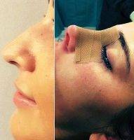 Before And After Nose Reshaping Surgery In CO