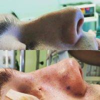 Before And After Nose Surgery Operation For Man In Oklahoma City Pictures
