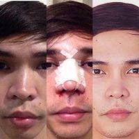 Before And After Operation Nose Singapore Asian Patient Photos