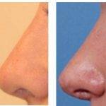 Before And After Revision Nose Correction In OKC