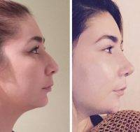 Before And After Rhinoplasty Procedure In Houston TX Photos