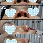 Best Rhinoplasty Surgeon For Asian Nose Pictures