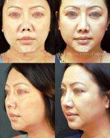 Bossier City Louisiana Rhinoplasty Asian Before And After Photo
