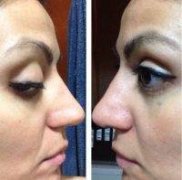 CA Most Requested Nose Job