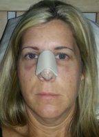Canada Good Rhinoplasty Can Modify The General Outline Of The Tip Or Of The Bridge