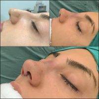 Cosmetic Surgery Nose Reshaping In Miami Before And After Images