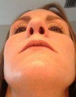 Cosmetic Surgery Revision Nose Reshaping In Canada