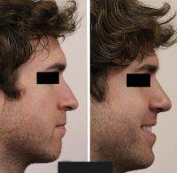 D.C. Male Plastic Surgery Of Nose Before And After Photos
