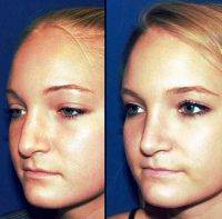 Dr Laxmeesh Mike Nayak Saint Louis, MO Nose Surgery Photos Before And After