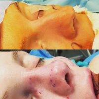 El Paso Plastic Surgery On The Nose Preop And Postop