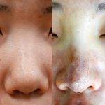 Ethnic Asian Cosmetic Surgery For Nose Before And After Photo