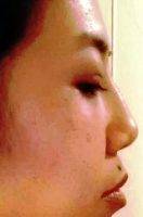 Ethnic Nose Asian - Natural And Subtle Results