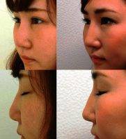 Ethnic Nose Rhinoplasty For Asian Nose
