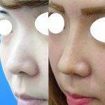 Ethnic Nose Surgery Before And After Photos