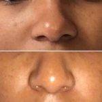 Ethnic Plastic Surgery Nose For Women Before And After
