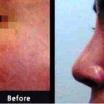 Ethnic Pretty Nose With Dr. Donald Yoo