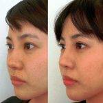 Ethnic Rhinoplasty Before After