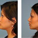 Ethnic Rhinoplasty Before And After