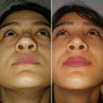 Good Rhinoplasty For Asian Before And After