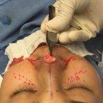 It Is Important To Work With A Plastic Surgeon Who Is Very Experienced In Shaping Asian Noses