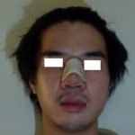 Korean Nose Plastic Surgery