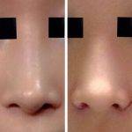 Korean Plastic Surgery Nose Pic
