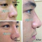 Korean Rhinoplasty Before And After (2)