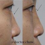 Korean Rhinoplasty Before And After (3)
