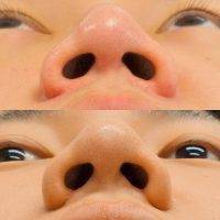Korean Rhinoplasty Pics Before And After Photos