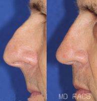 Lake Charles Louisiana Male Plastic Surgery Of Nose Before And After
