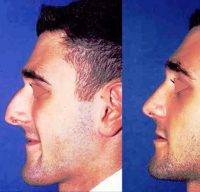 Lebanon Rhinoplasty Nose For Man