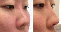 Maintaining And Improving The Nasal Function Is A Critically Important Part Of Successful Asian Rhinoplasty