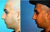 Male Cosmetic Surgery Of Nose In Denver Before And After Photo