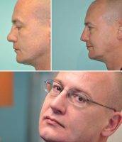 Male Nose Job In TN Is A Surgery To Change The Shape Of The Nose