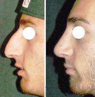 Male Nose Job Operation In Alberta, Canada By Dr. Paul Whidden Preop and postop