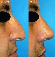 Male Nose Surgery Antwerpen Belgium Before And After Photos