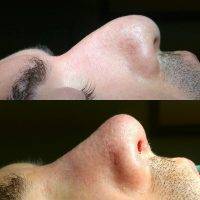 Male Nose Surgery In CA Before And After Photos