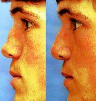 Male Nose Surgery Poland Can Also Correct Breathing Anomalies