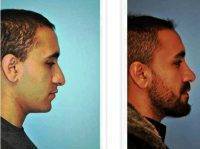 Male Plastic Surgery For The Nose In Istanbul Turkey Before And After Photos