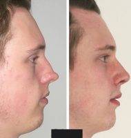 Male Reshaping Of The Nose In Manchester Before And After