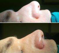 Male Rhinoplasty Before And After In Austin Texas