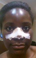 Manchester African American Nose Job For Natural Looking Nose With Normal Breathing