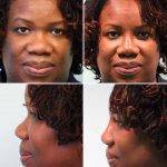 Montreal African American Nose Job With Dr Mark Samaha MD Can Reshape Your Nose In A Number Of Ways