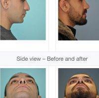 Nasal Surgery For Man In Singapore Before And After
